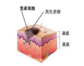 黑色素瘤是什么？怎么治疗？